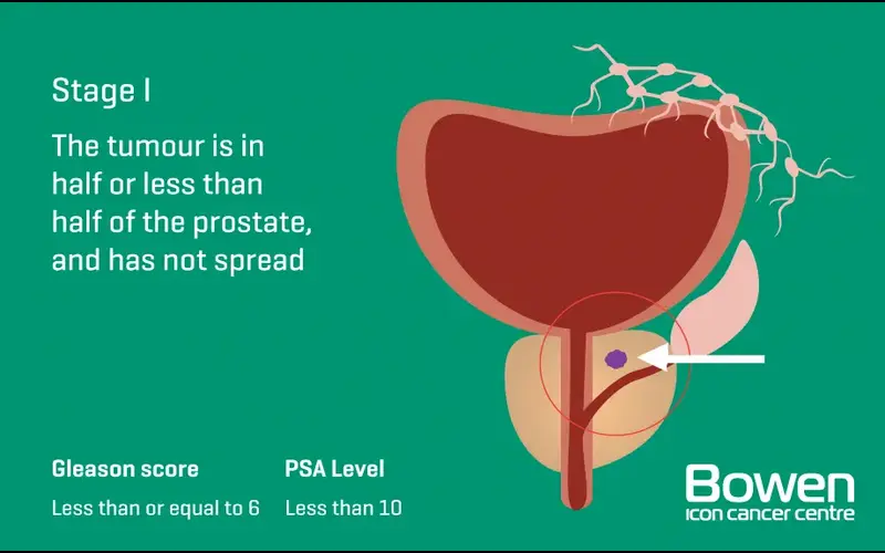 Illustration of Stage 1 prostate cancer