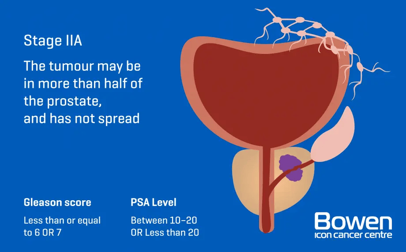 Illustration of Stage 2 prostate cancer