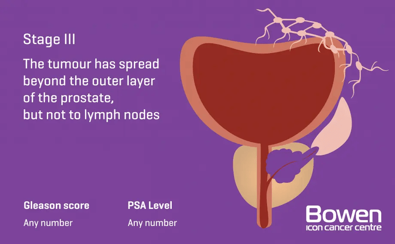 Illustration of Stage 3 prostate cancer