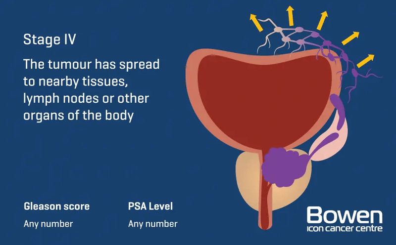 Illustration of Stage 4 prostate cancer